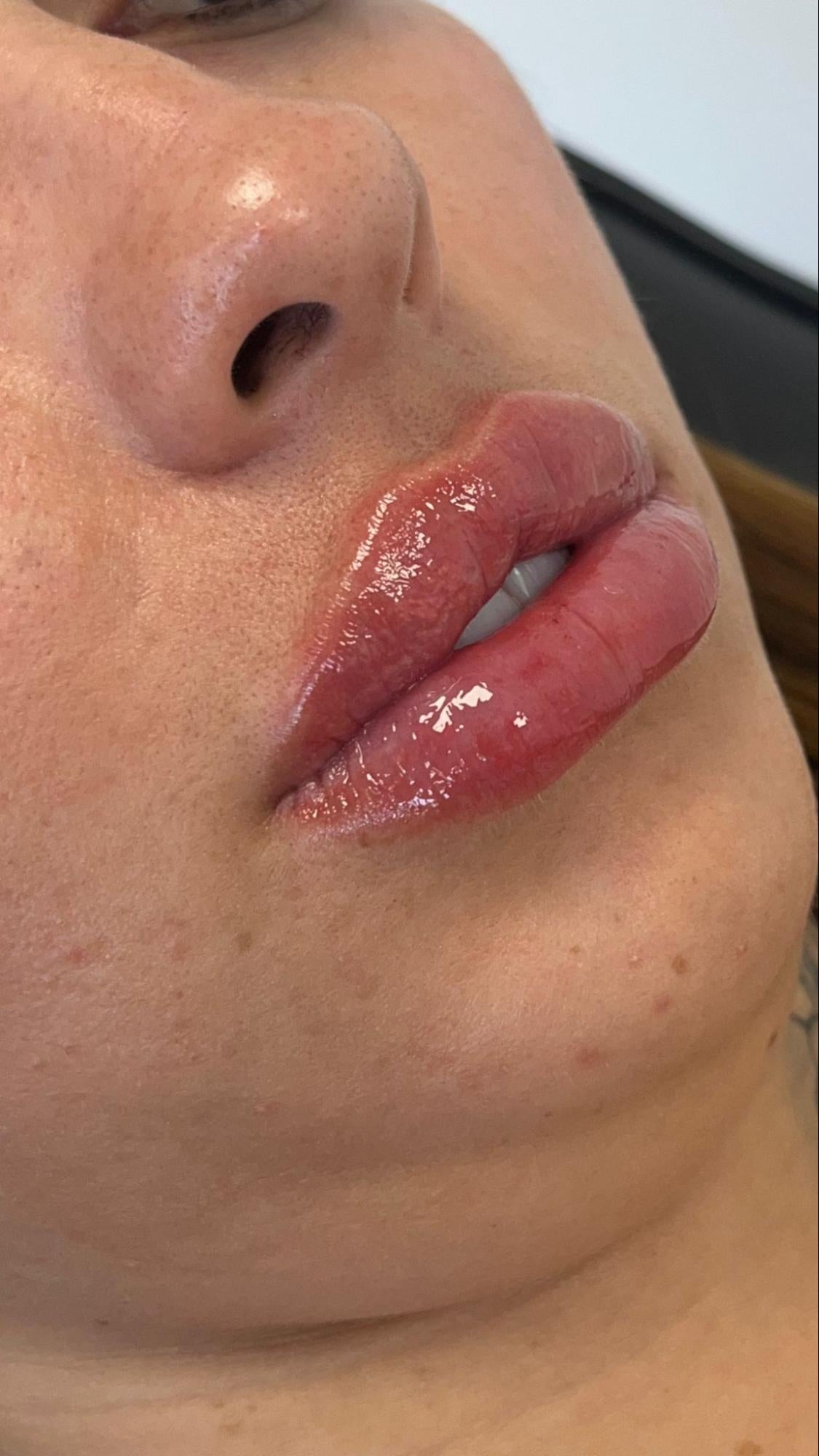 Preenchimento Labial