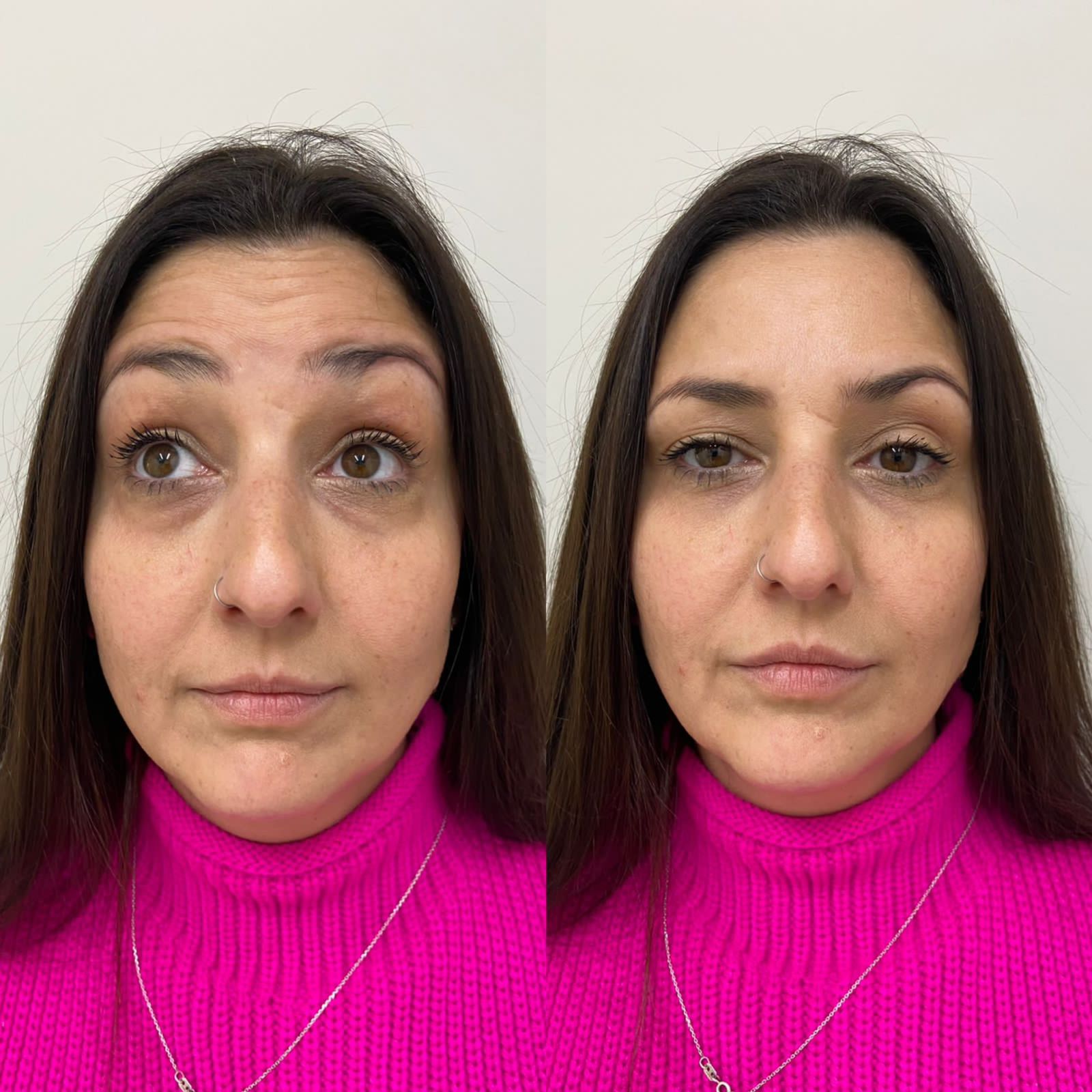 Botox 50 UI (unidades internacionais)
