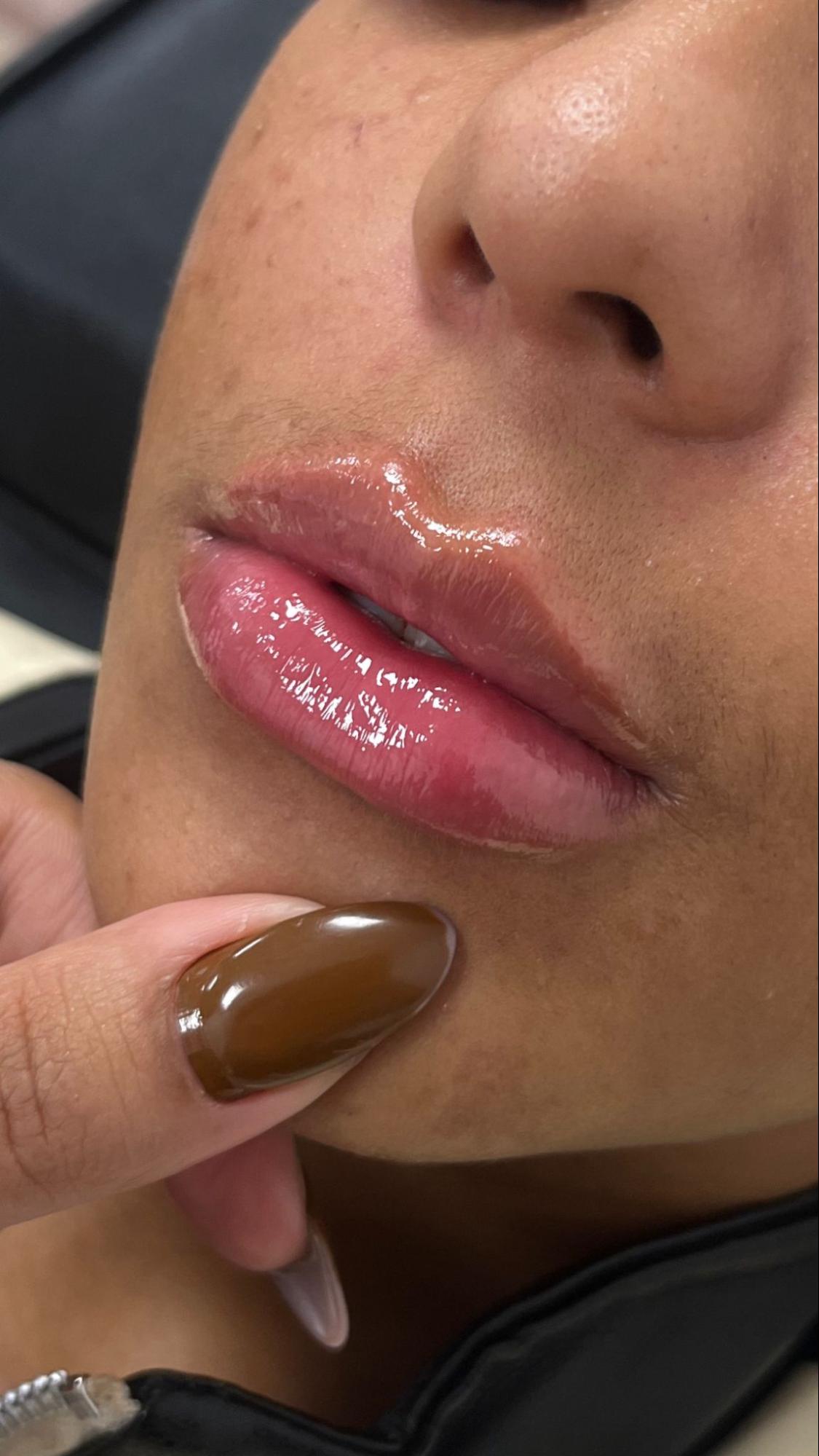 Preenchimento Labial