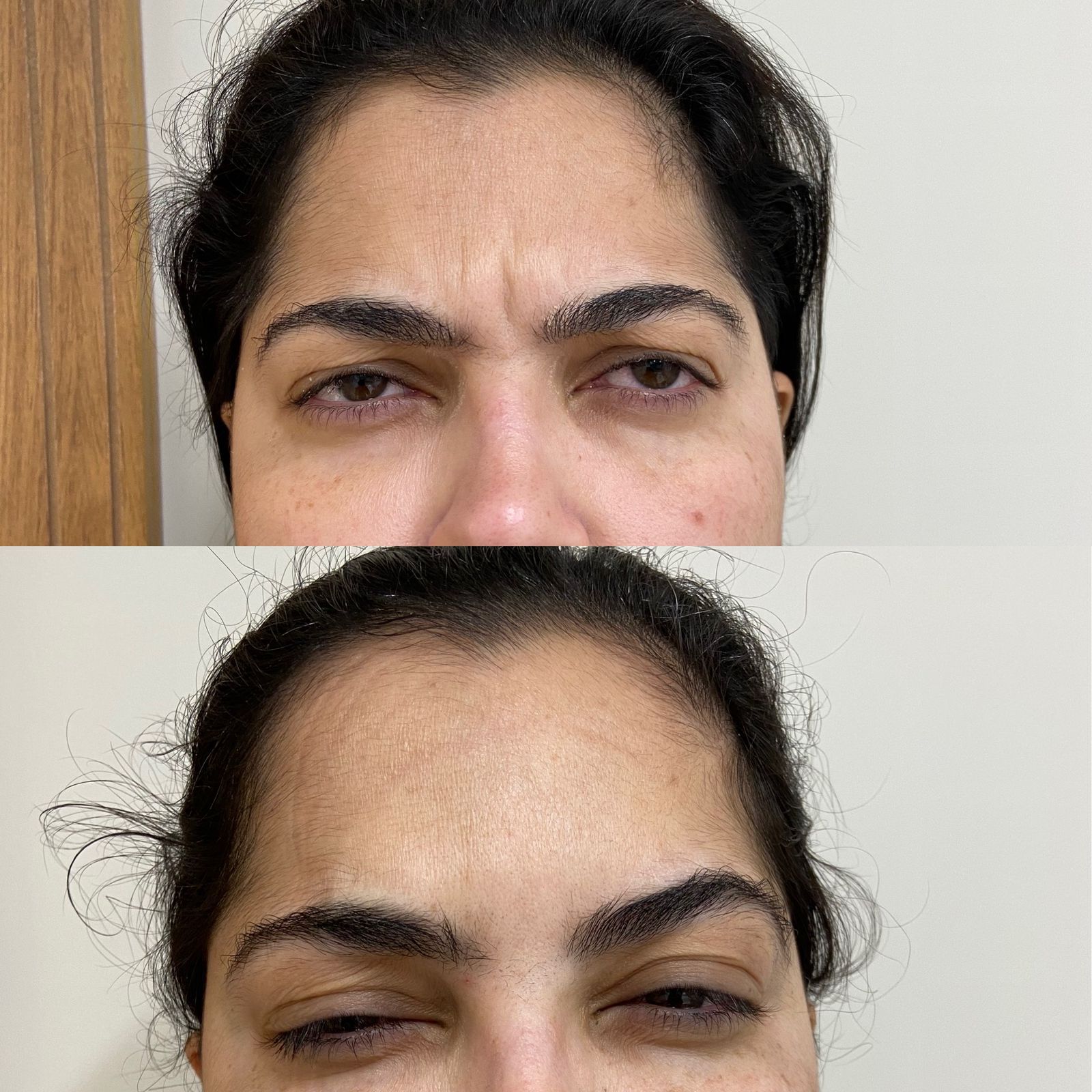 Botox 50 UI (unidades internacionais)