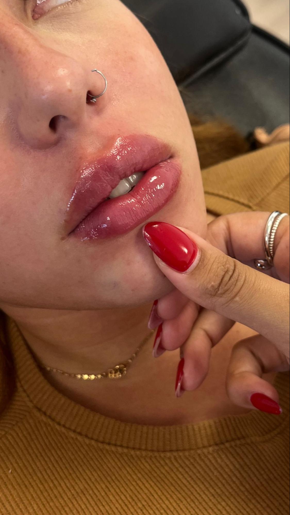 Preenchimento Labial