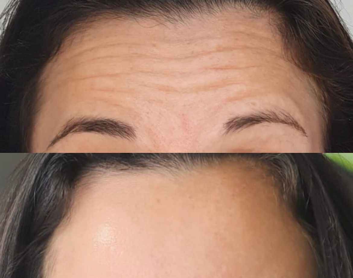 Botox 50 UI (unidades internacionais)